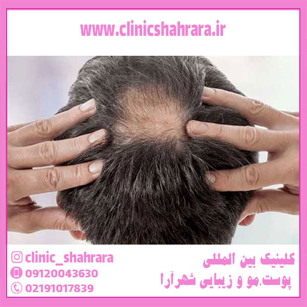 جلوگیری از ریزش مو _راهکارهای موثر در درمان ریزش مو